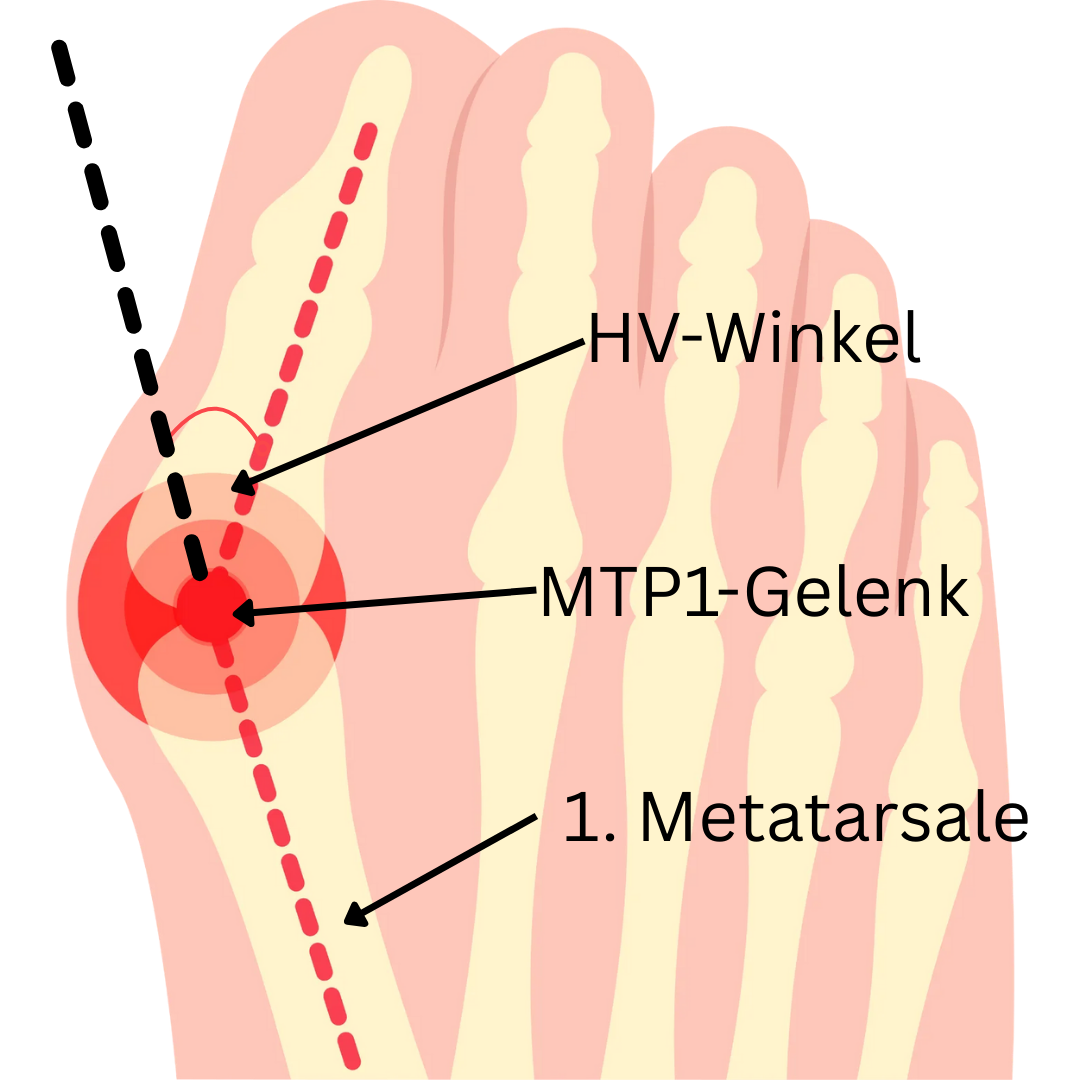 Der HV-Winkel ist maßgeblich für die Einstufung der Schwere eines Hallux Valgus. Hier ist er auf dem Skelett eines Fußes mit HV eingezeichnet.