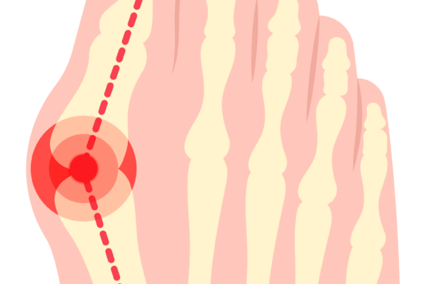 Hallux valgus – Symptome, Ursachen und Therapie