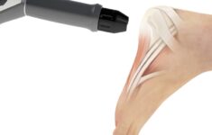 Die radiale Stoßwelle in der physiotherapeutischen Anwendung zur Behandlung eines Fersensporns.